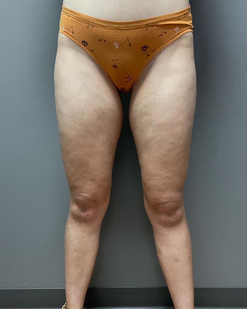 Liposuction Knees Before & After Image
