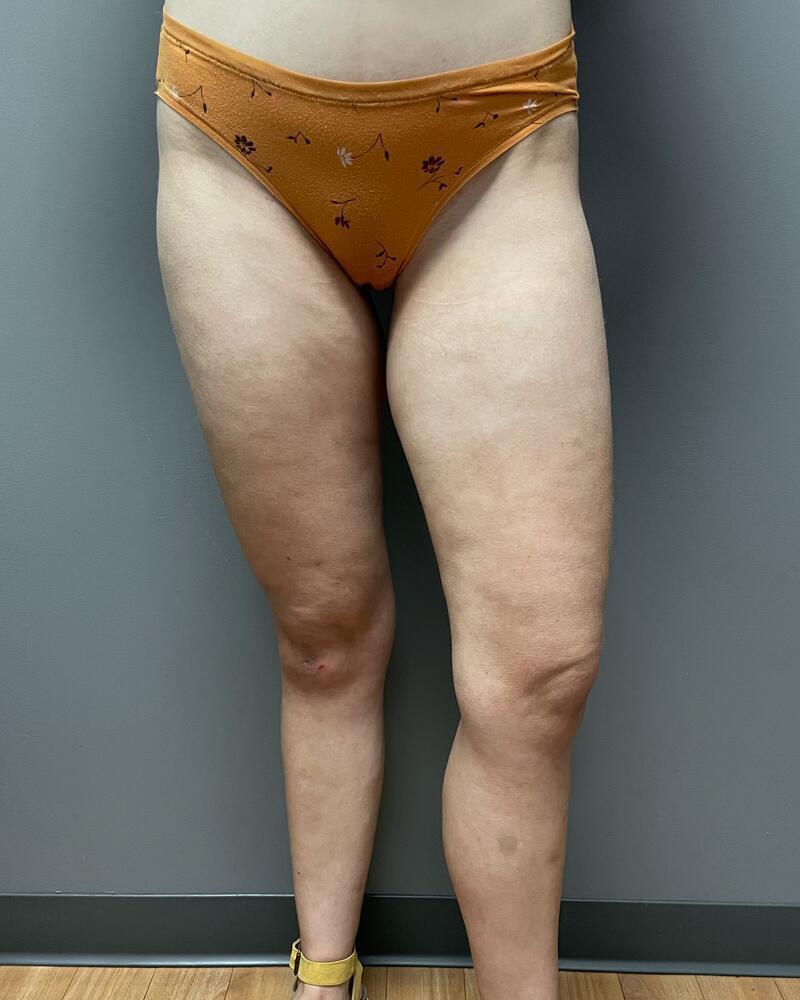 Liposuction Knees Before & After Image