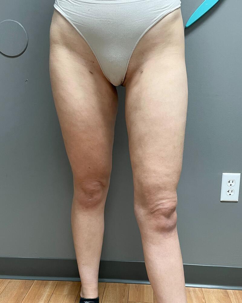 Liposuction Knees Before & After Image