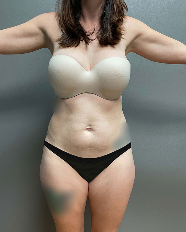 Sculptra Before & After Image