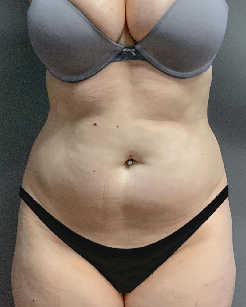 Sculptra Before & After Image