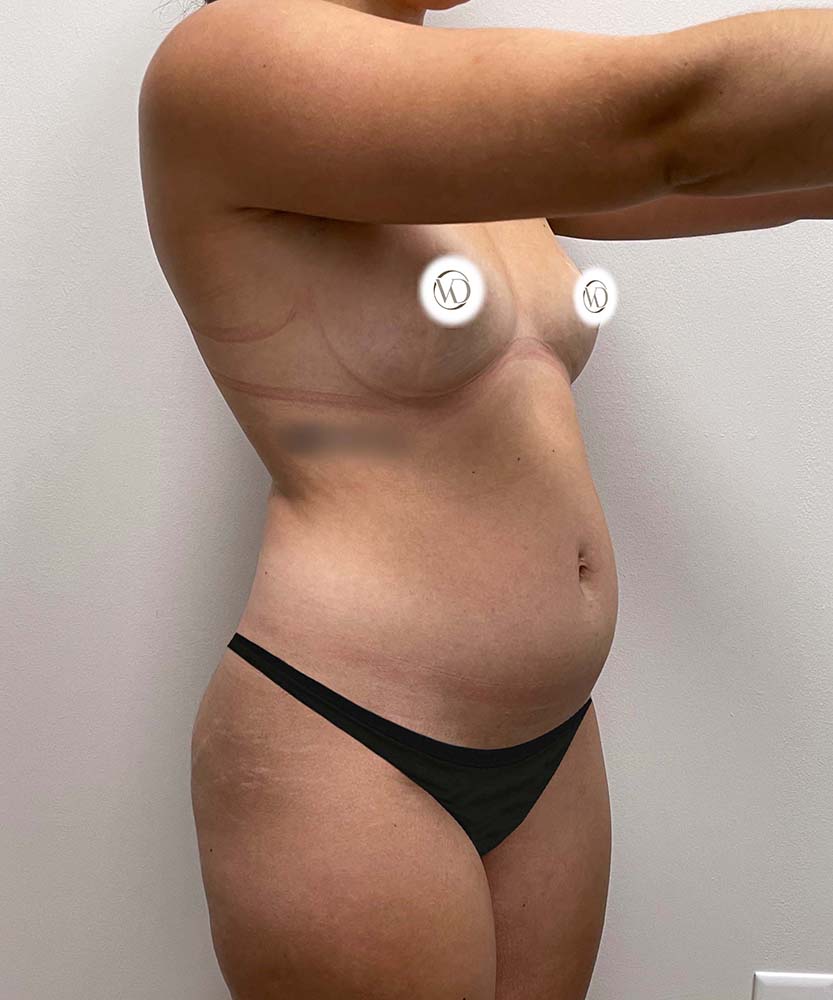 Liposuction Midsection Before & After Image