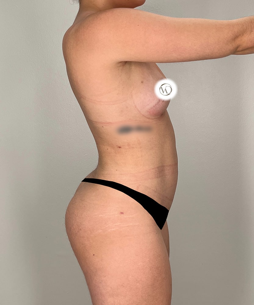 Liposuction Midsection Before & After Image