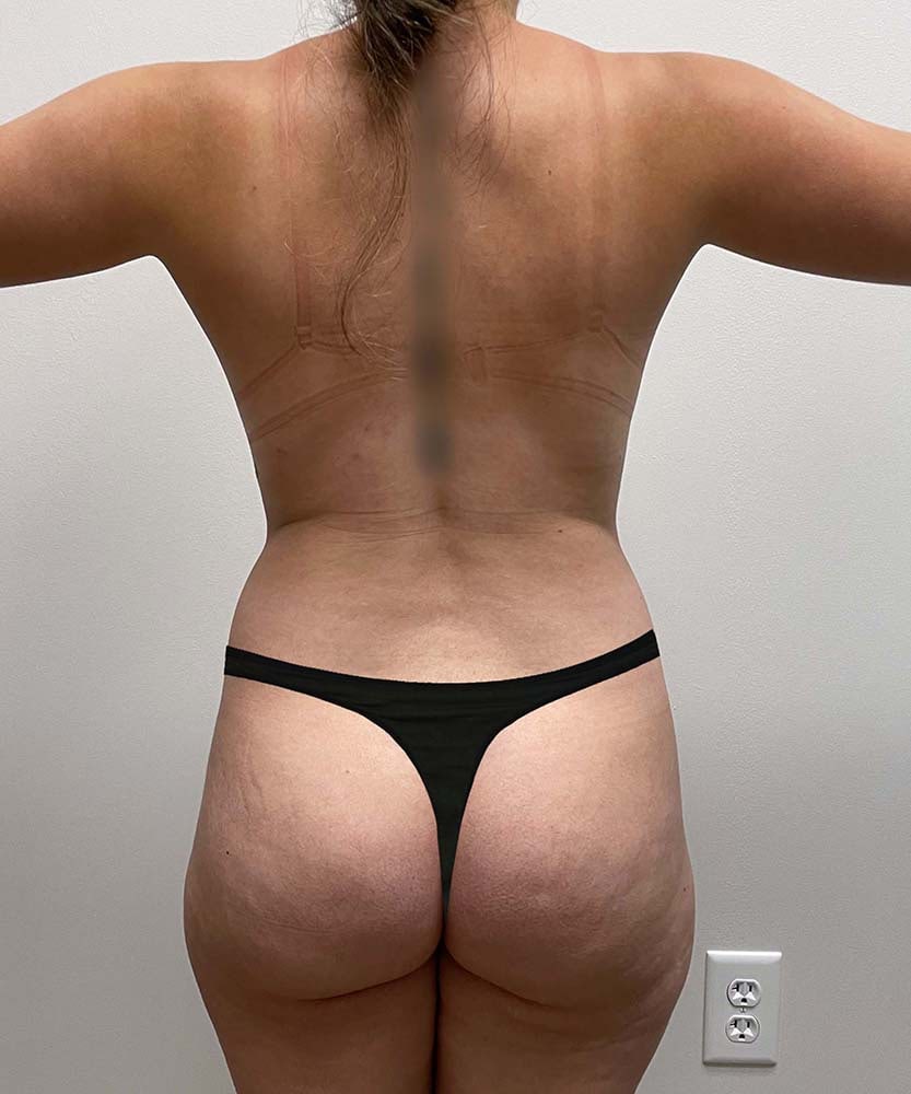 Liposuction Midsection Before & After Image