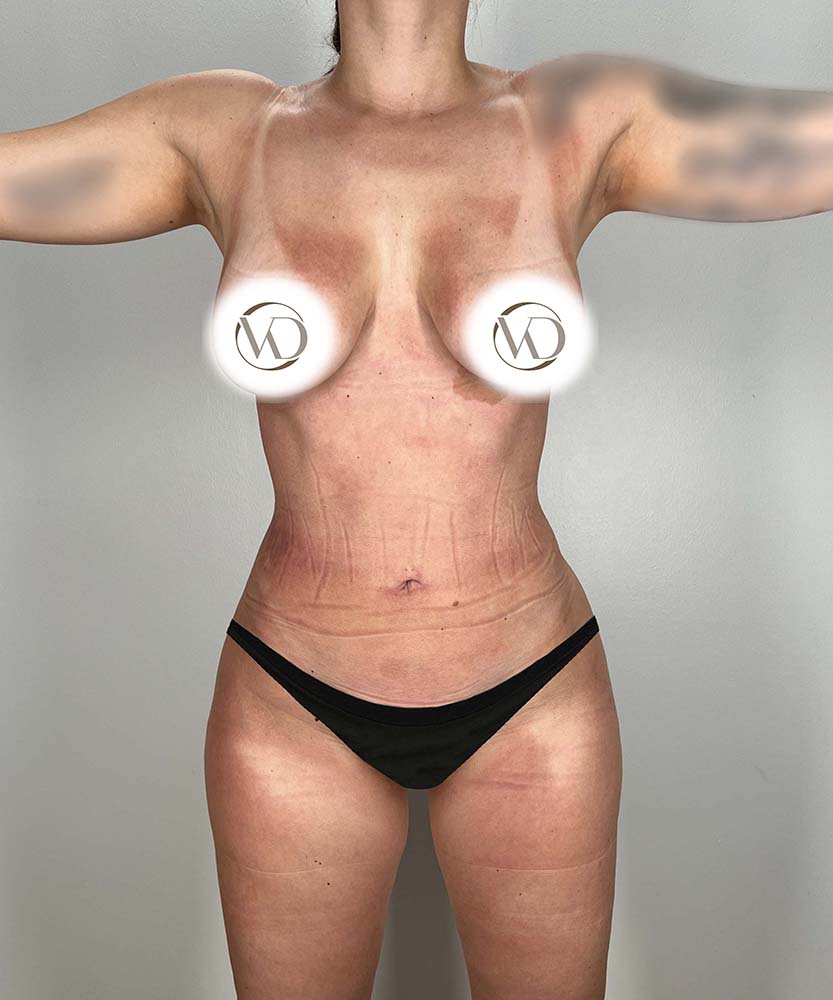 Liposuction Midsection Before & After Image