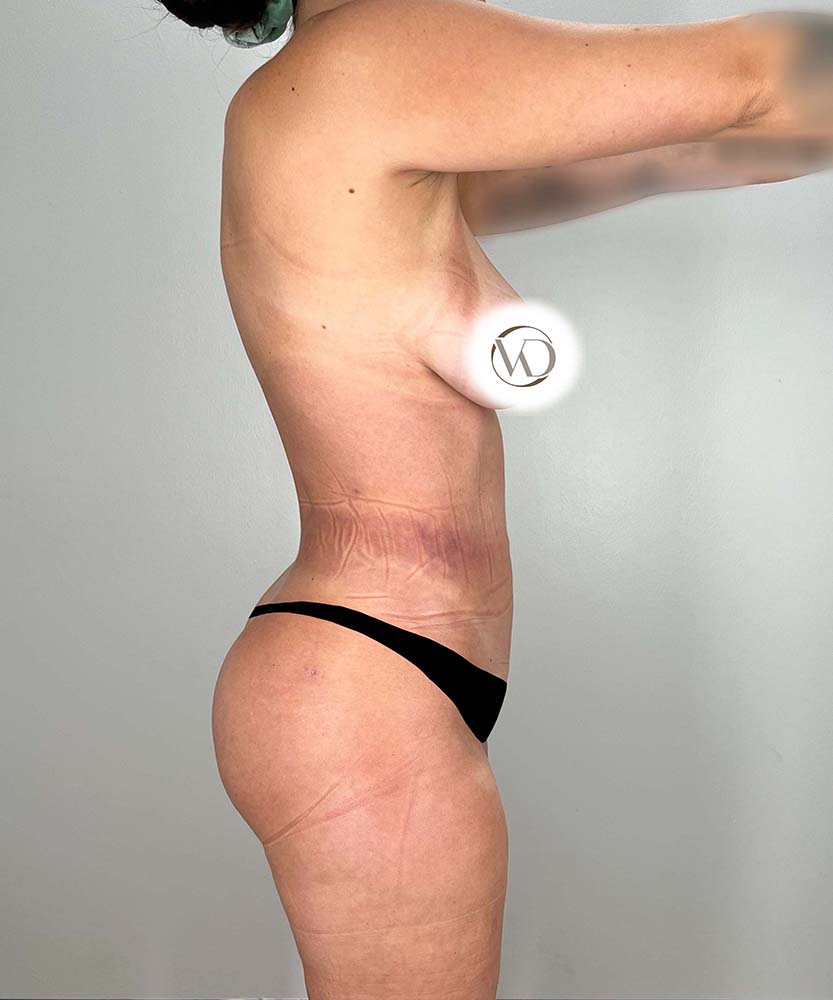 Liposuction Midsection Before & After Image