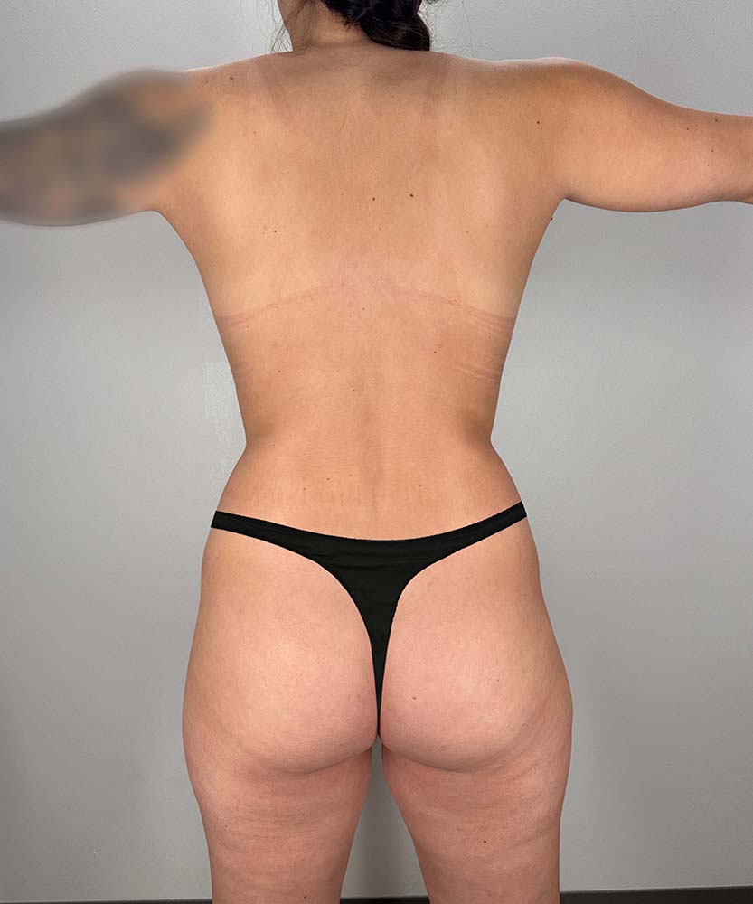 Liposuction Midsection Before & After Image