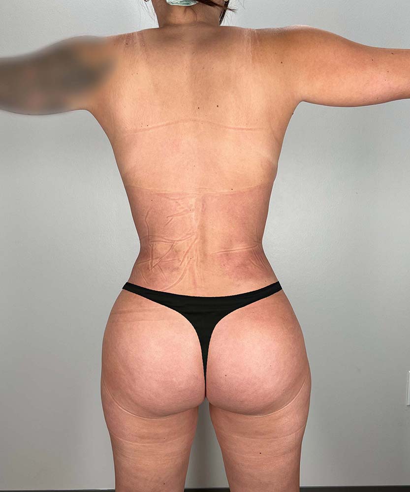 Liposuction Midsection Before & After Image