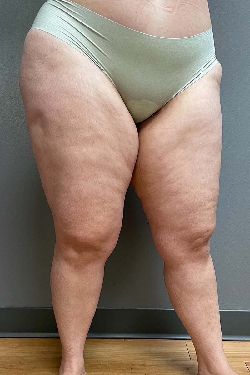 Liposuction Thighs Before & After Image
