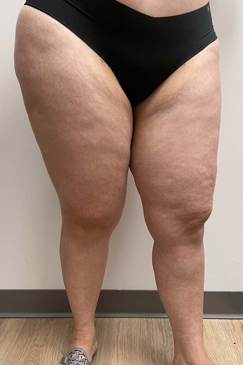 Liposuction Thighs Before & After Image