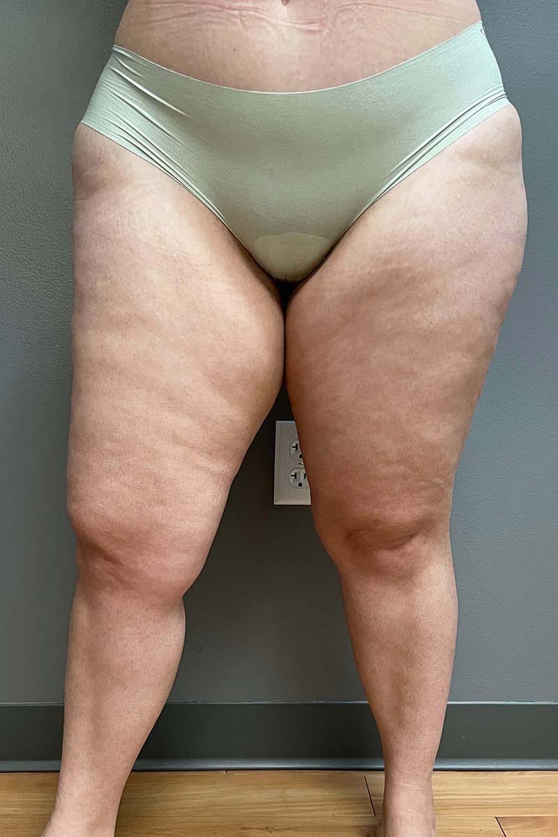 Liposuction Thighs Before & After Image