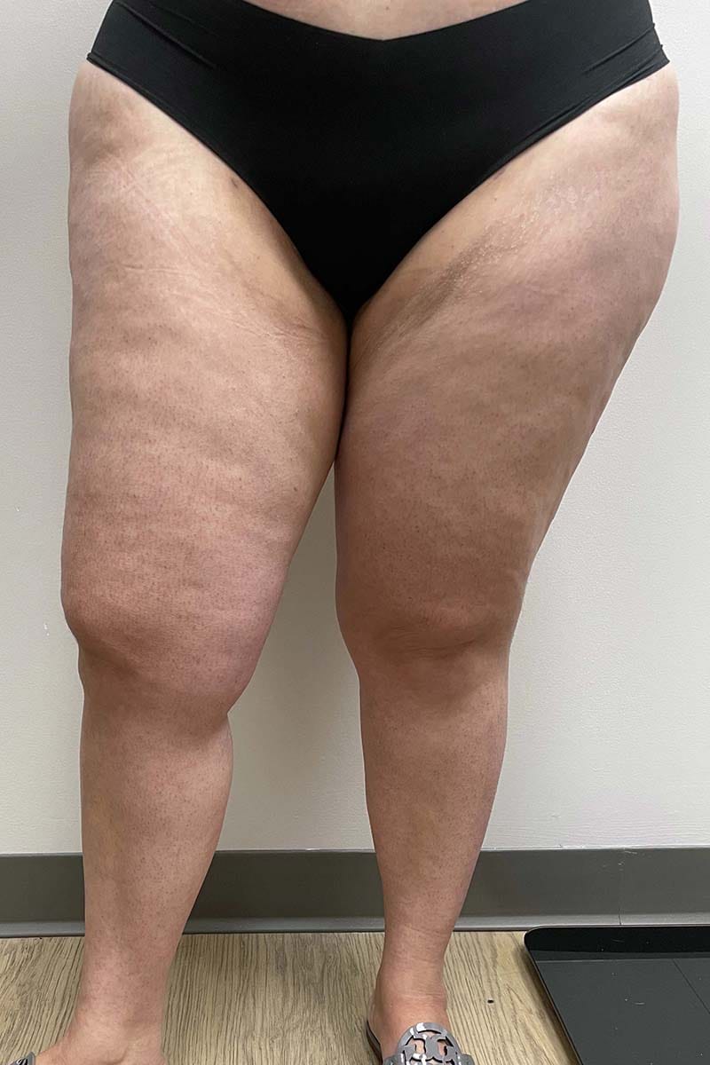 Liposuction Thighs Before & After Image