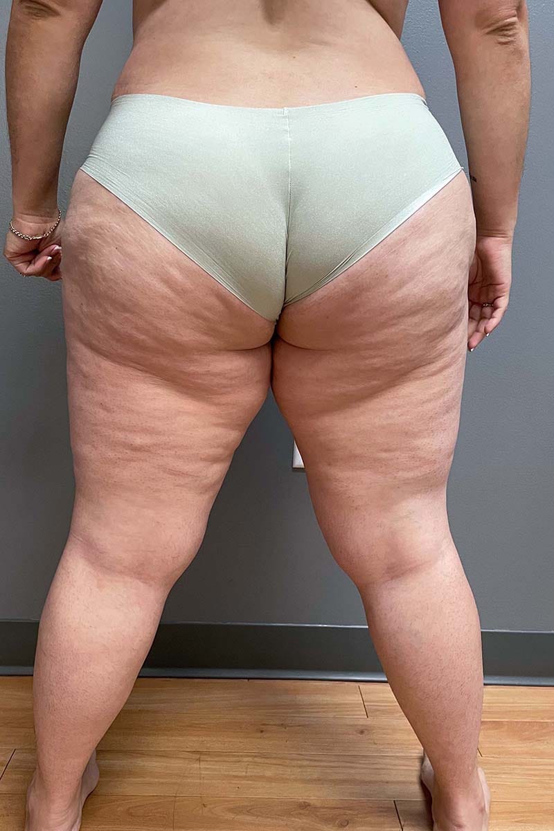 Liposuction Thighs Before & After Image