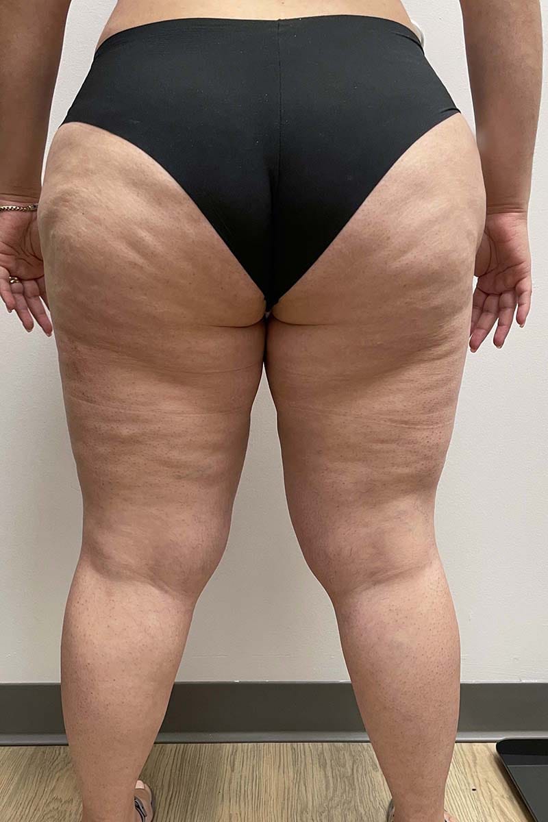 Liposuction Thighs Before & After Image