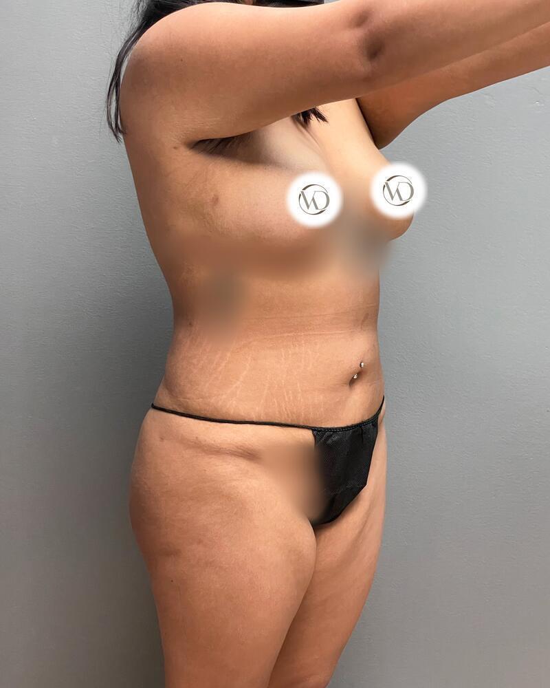 Liposuction Before & After Image