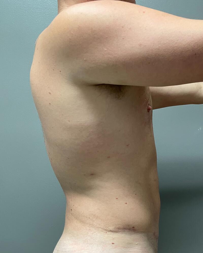 Liposuction Before & After Image