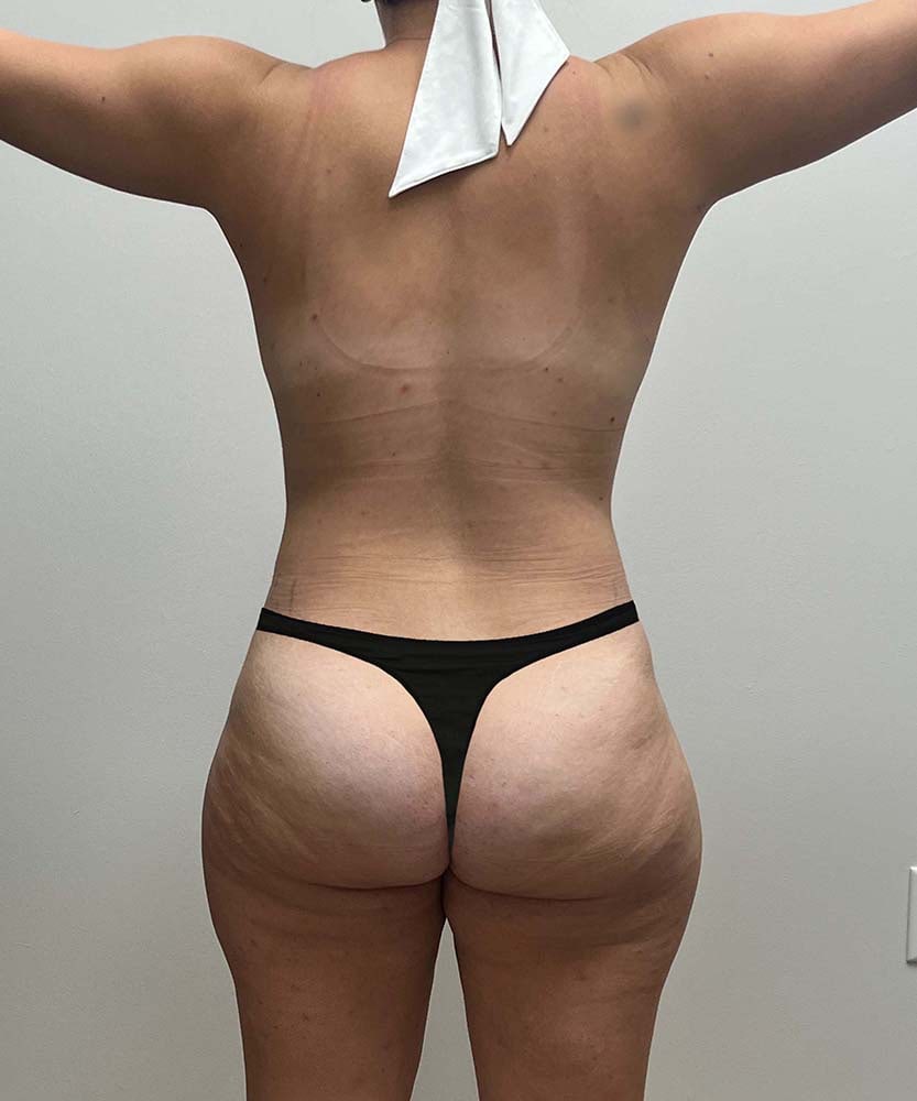 Liposuction Before & After Image