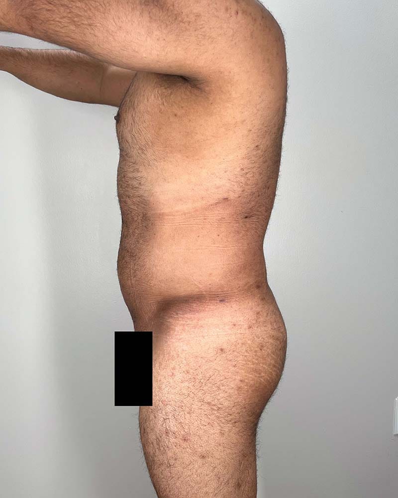 Liposuction Before & After Image