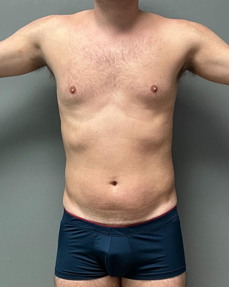 Sculptra Before & After Image