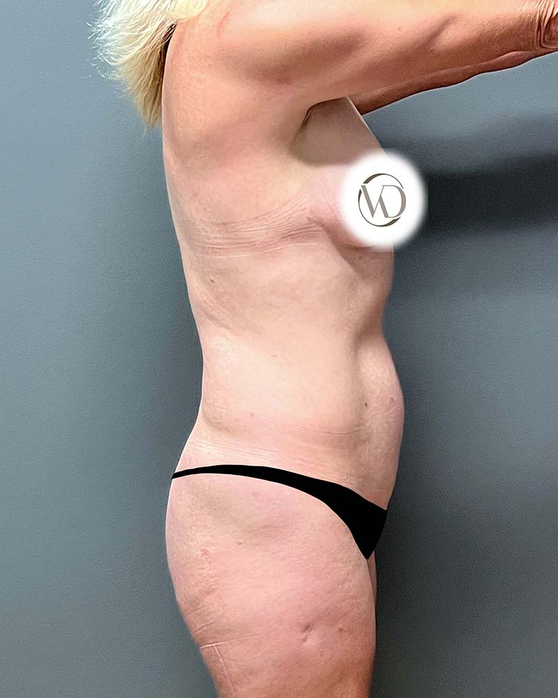 Mini Tummy Tuck Before & After Image