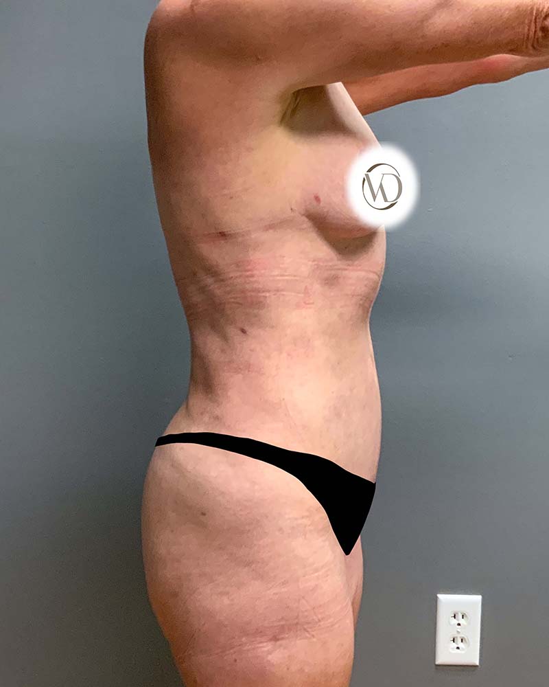 Mini Tummy Tuck Before & After Image