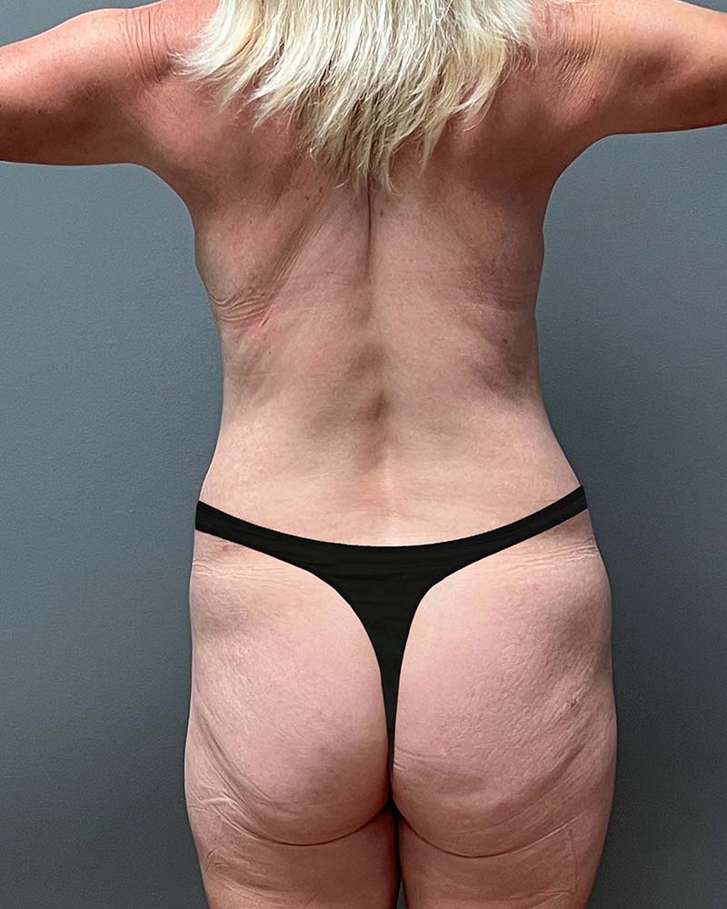 Mini Tummy Tuck Before & After Image