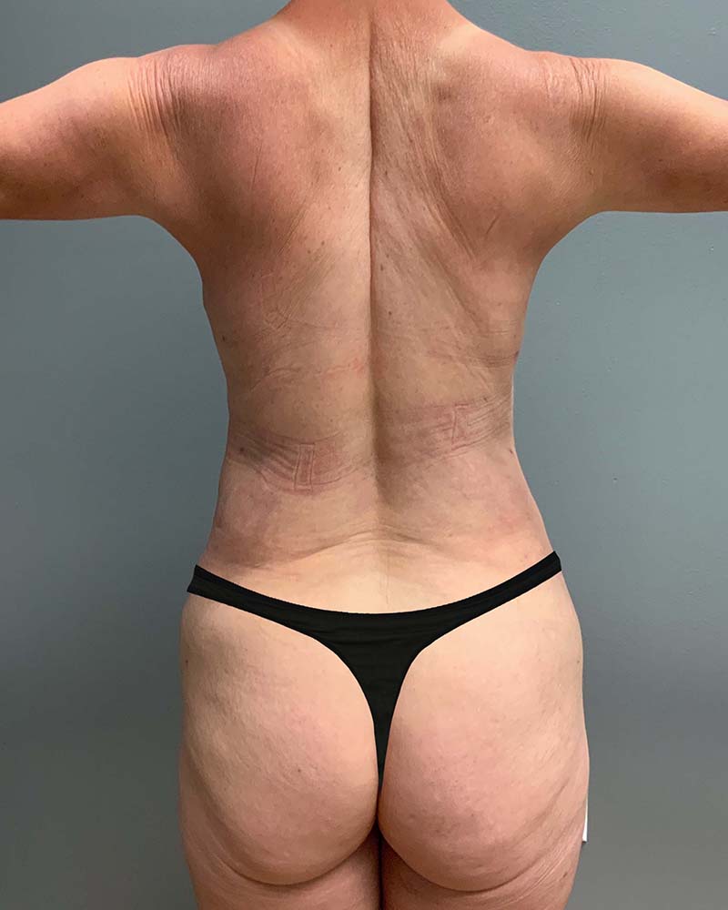 Mini Tummy Tuck Before & After Image