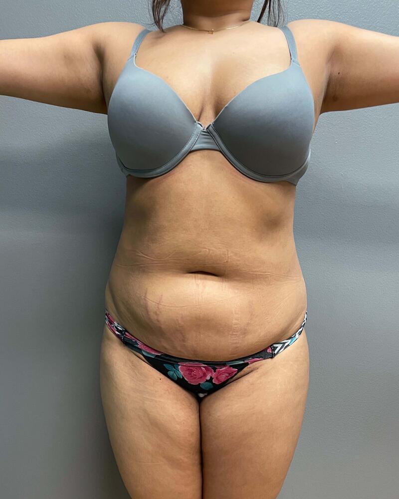 Mini Tummy Tuck Before & After Image