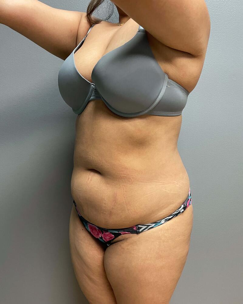 Mini Tummy Tuck Before & After Image