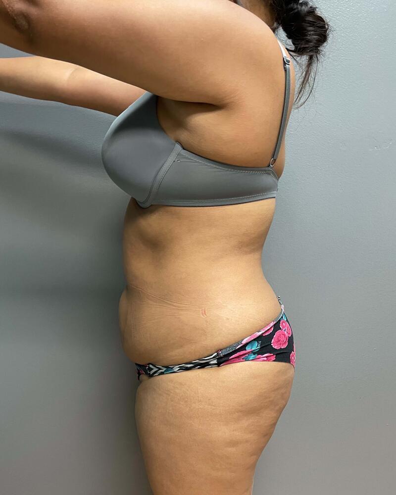 Mini Tummy Tuck Before & After Image