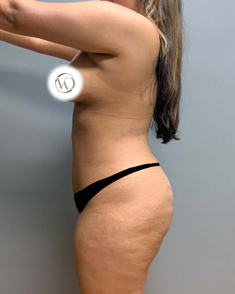 Mini Tummy Tuck Before & After Image