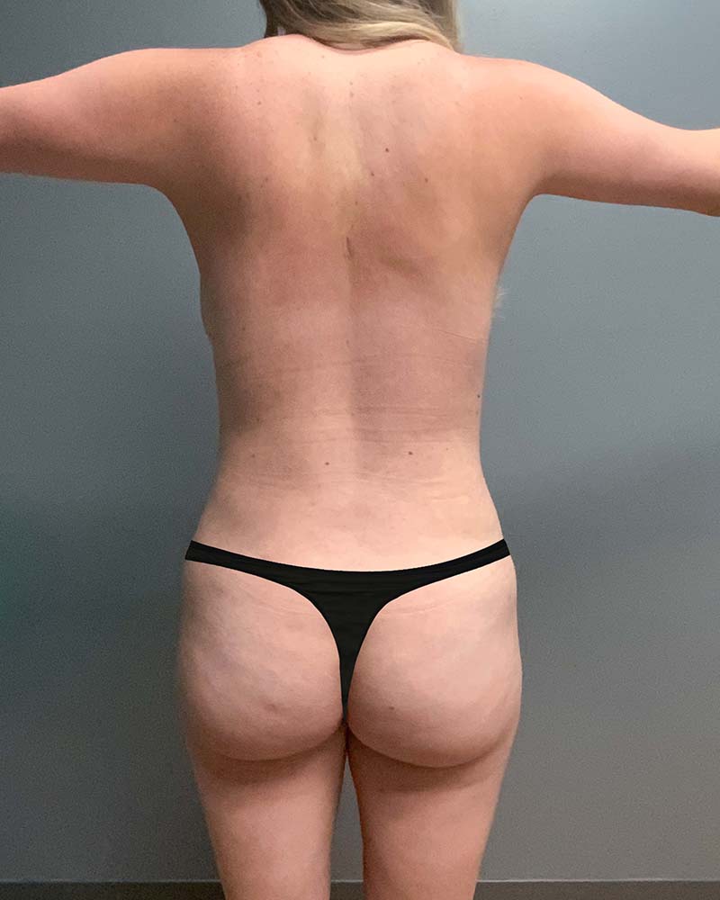 Mini Tummy Tuck Before & After Image