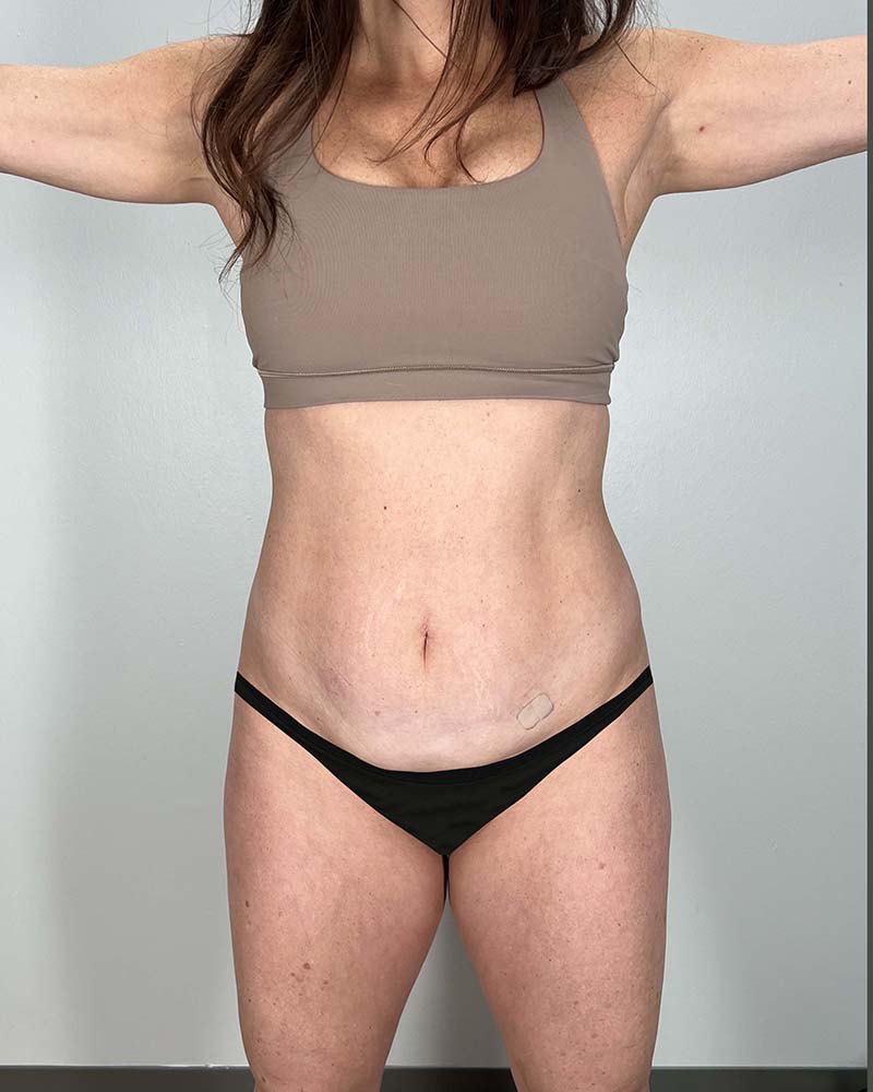Mini Tummy Tuck Before & After Image