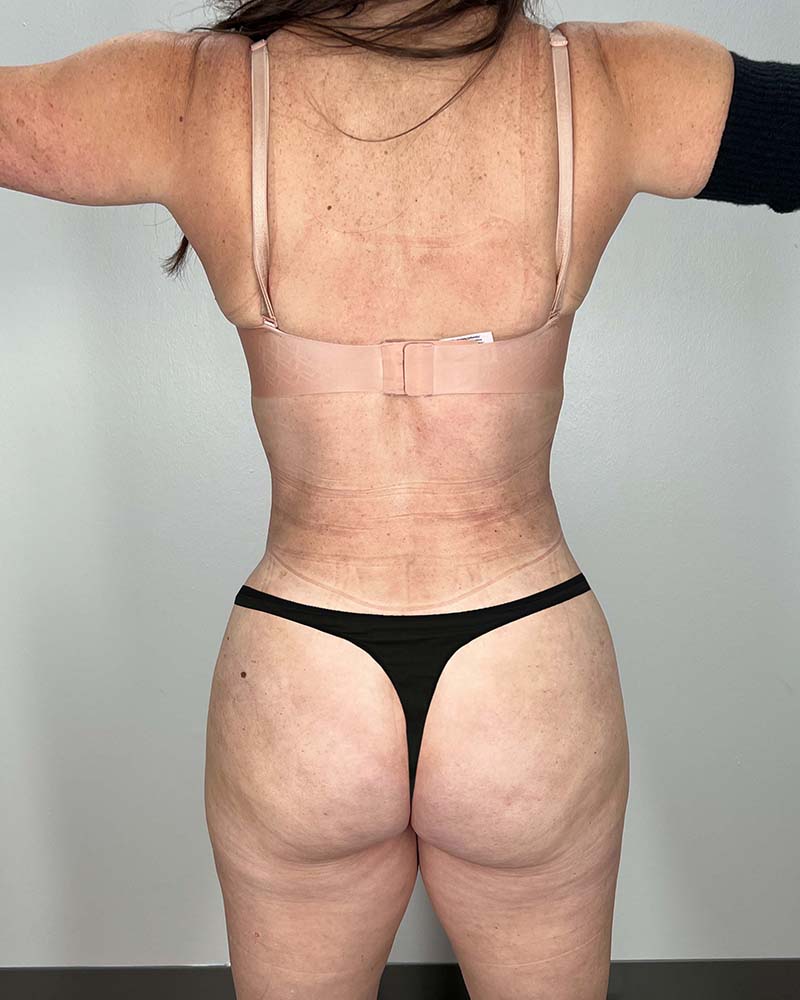 Mini Tummy Tuck Before & After Image