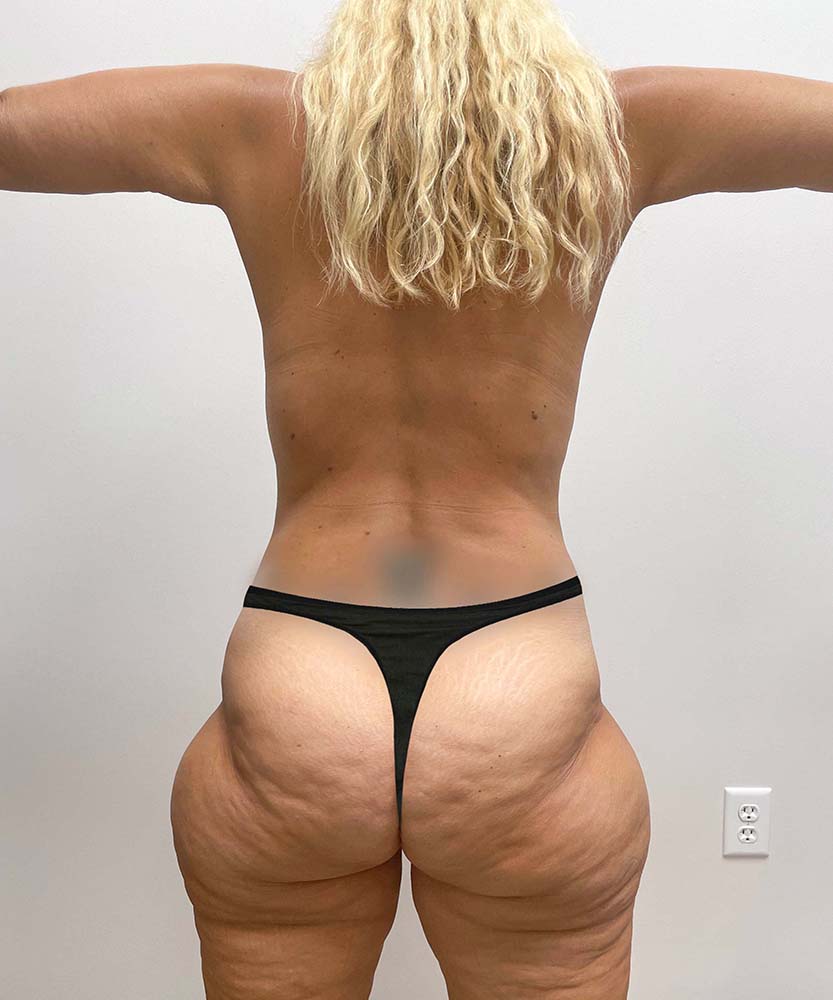 Mommy Makeover Before & After Image