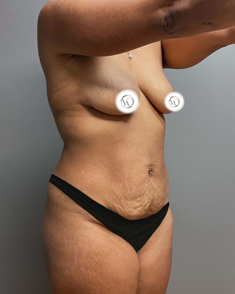Mommy Makeover Before & After Image
