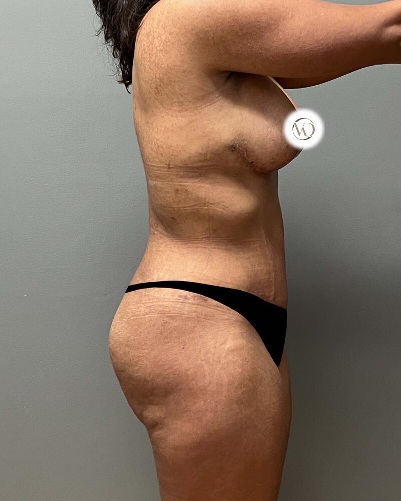 Mommy Makeover Before & After Image