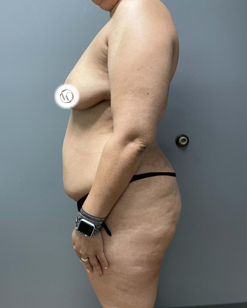Mommy Makeover Before & After Image