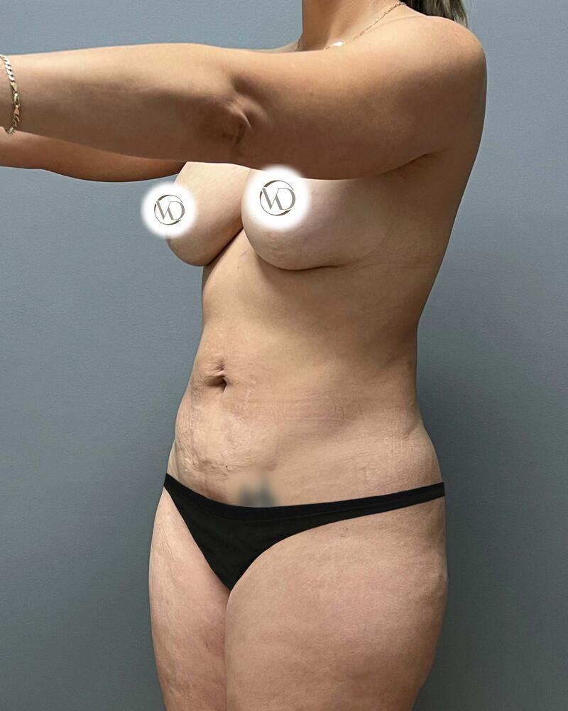 Mommy Makeover Before & After Image