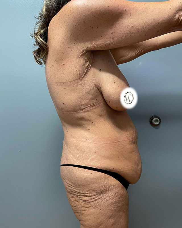 Mommy Makeover Before & After Image