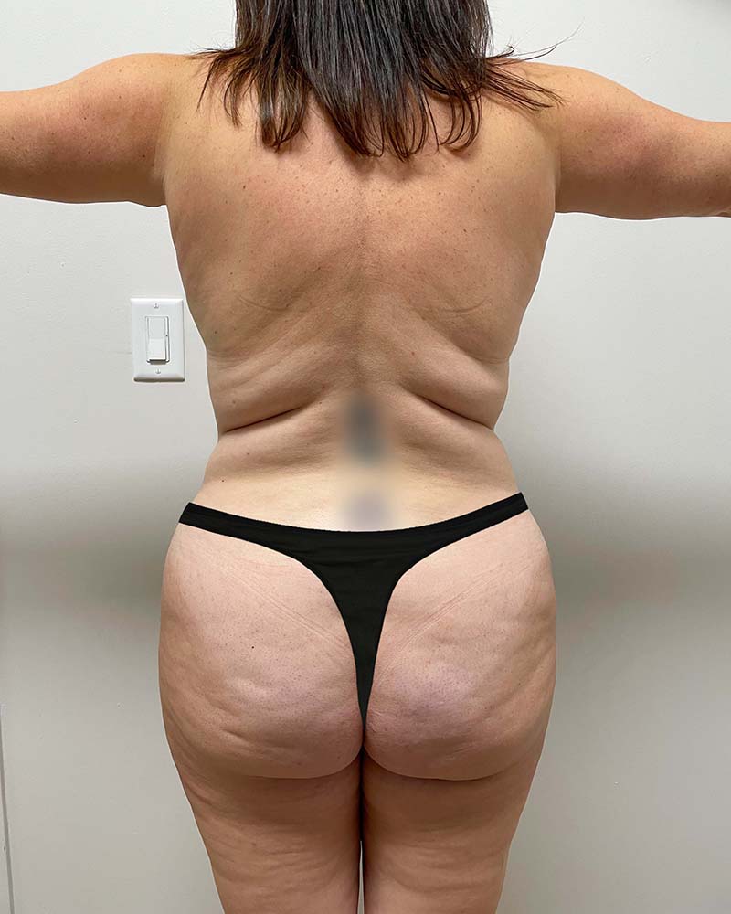 Mommy Makeover Before & After Image