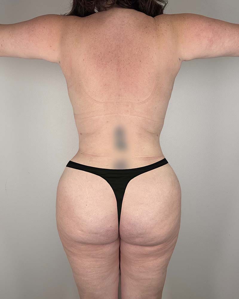 Mommy Makeover Before & After Image