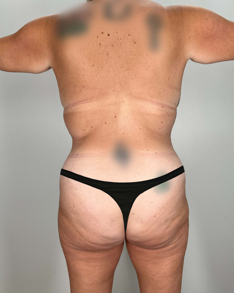 Mommy Makeover Before & After Image