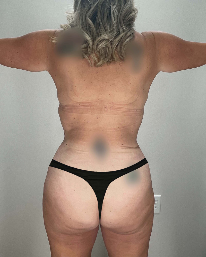 Mommy Makeover Before & After Image