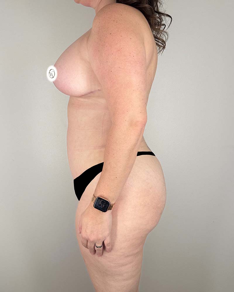 Mommy Makeover Before & After Image