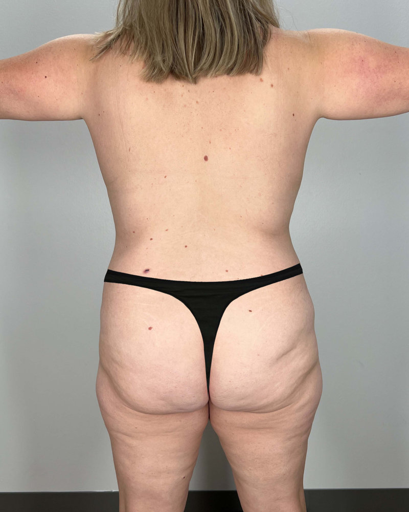 Mommy Makeover Before & After Image