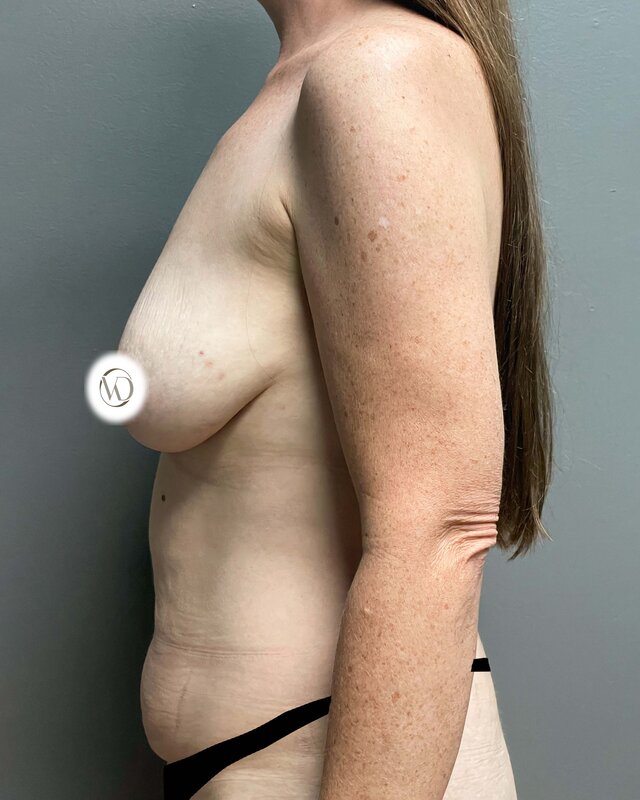 Mommy Makeover Before & After Image