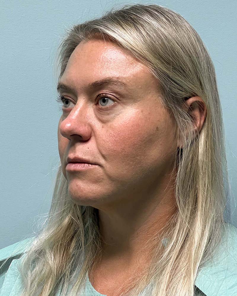 Renuvion Before & After Image