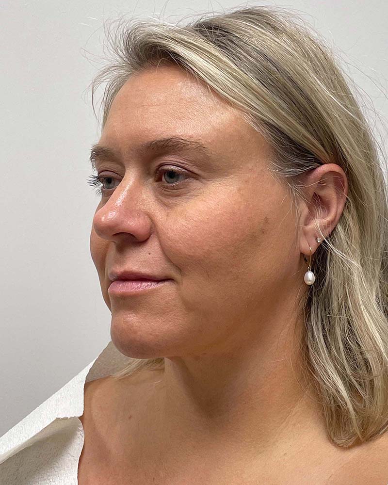 Renuvion Before & After Image