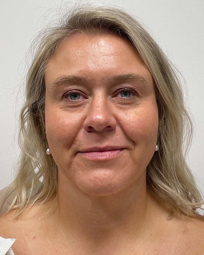 Renuvion Before & After Image